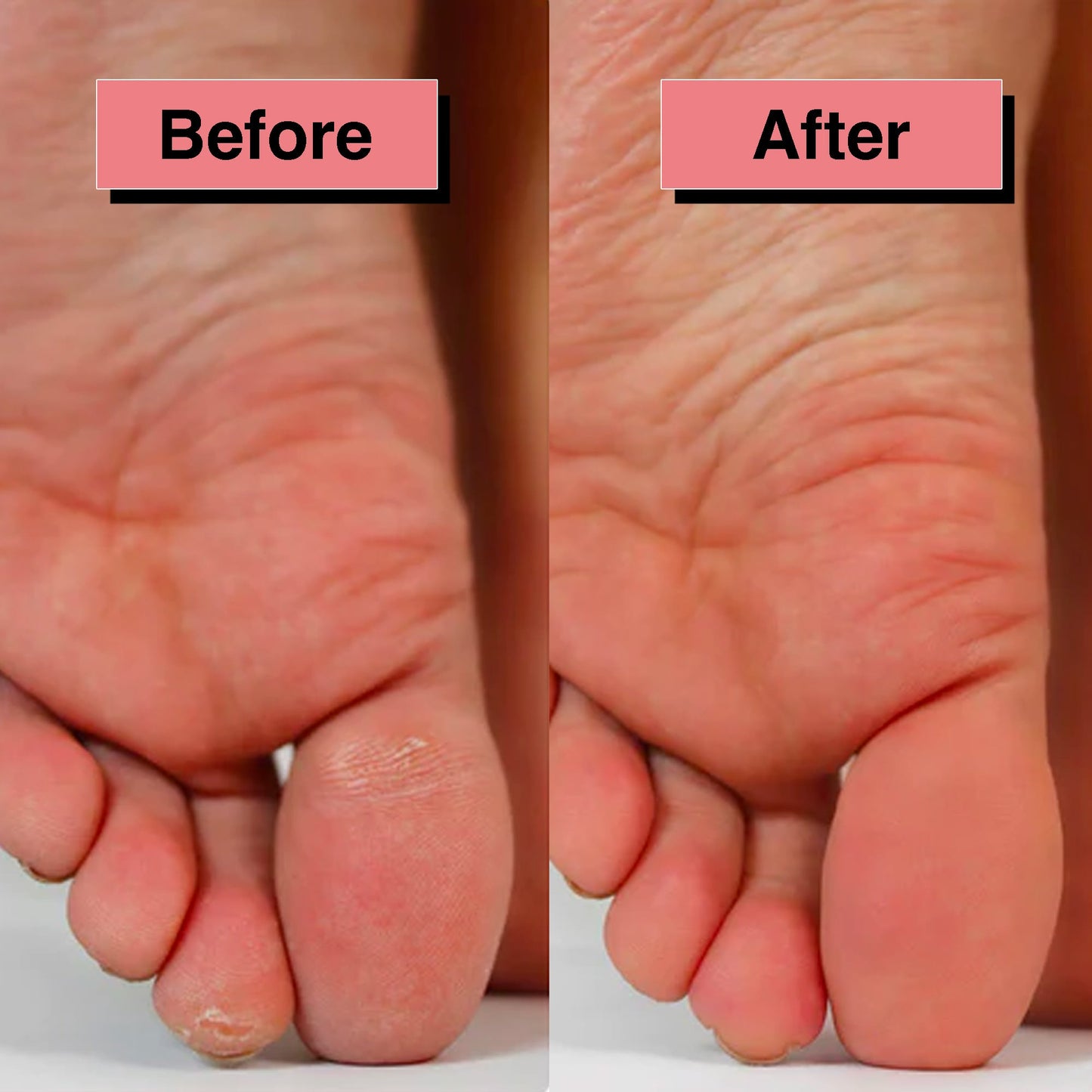 PEDIWAND™ - Foot Callus Remover