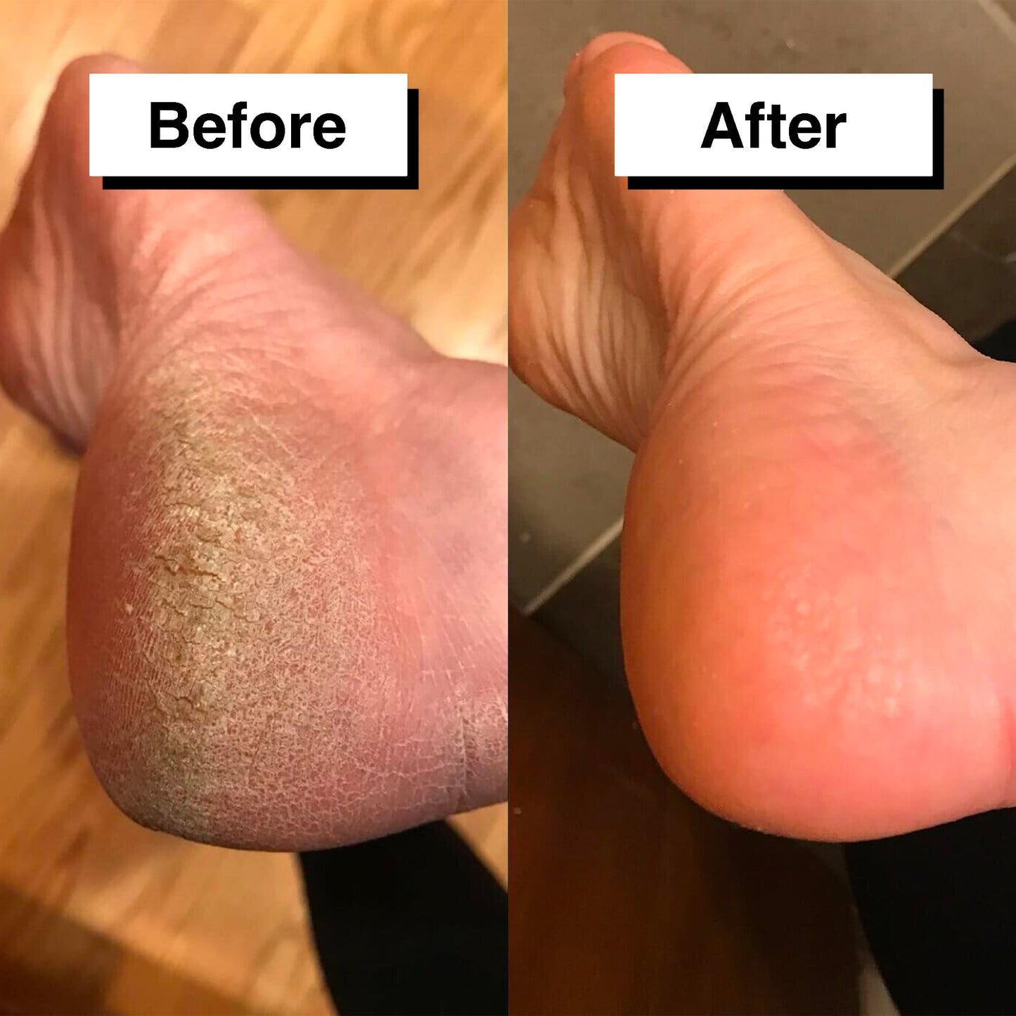 Free Automatic Callus Remover + 10 Grinders